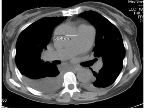 Preoperative Computed Tomography Showed A Dilated Ascending Aorta