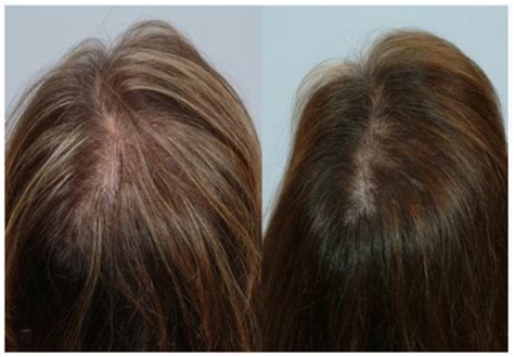 Hair Loss In Women Understanding The Symptoms And Causes