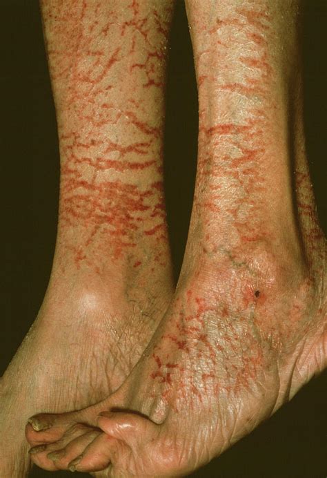 Asteatotic Eczema Photograph By Cnriscience Photo Library Fine Art