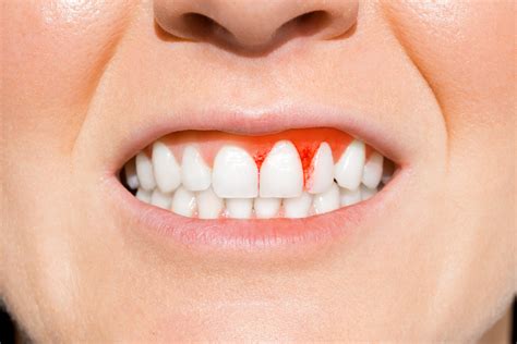 Gum Disease Treatment 101