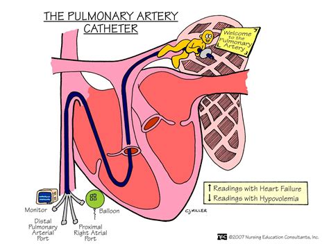 The Pulmonary Arterial Catheter Medical Surgical Nursing Surgical