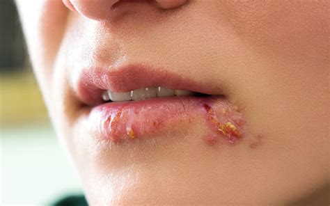 Pimples Vs Cold Sore On Skin Causes Treatments And Prevention Skinkraft