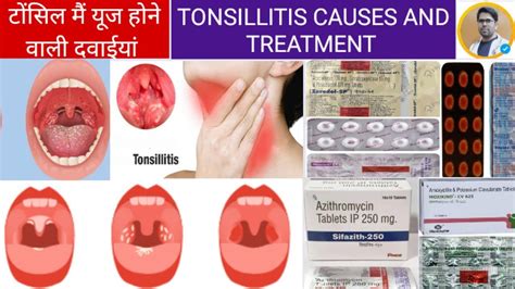 Tonsillitis Tonsillitis Causes Causes Symptoms