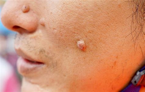 Cysts Lumps Bumps And Your Skin