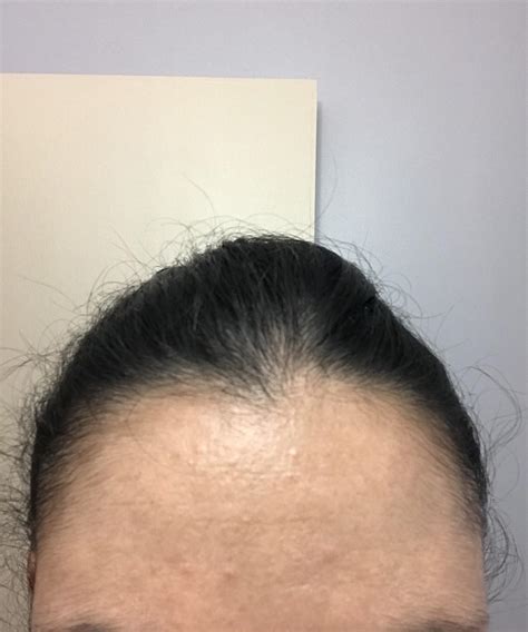 Skin Concerns How Do I Get Rid Of These Bumps On My Forehead