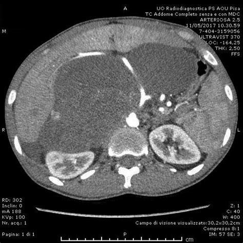 Ct Scan With Contrast Showing A Huge Retroperitoneal Mass Compressing