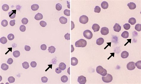 Normal Platelets Cells And Smears
