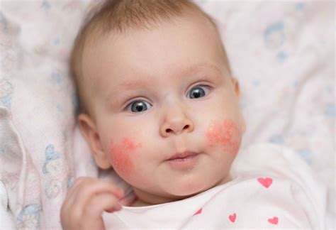 Real Life Experience Allergic Reaction Symptoms Babies