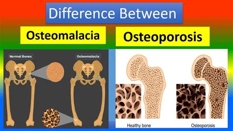 Difference Osteomalacia And Osteoporosis Youtube