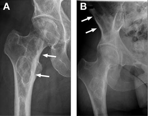A B Anteroposterior Radiographs Of The Proximal Femur And Right Hip