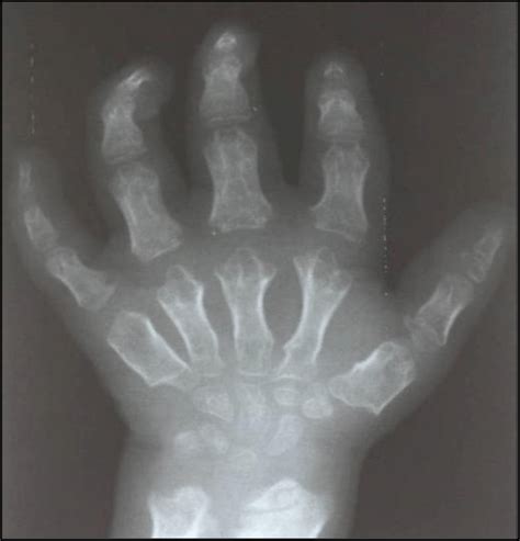 Exame Radiográfico De Mão E Punho Esquerdo Para Análise Da Idade óssea