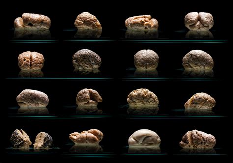 The Worlds Largest Collection Of Malformed Brains In Human Brain Mental Hospital Brain