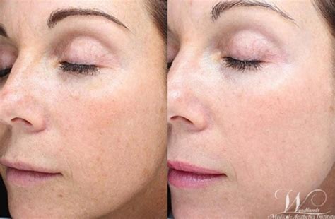 Halo™ Laser Skin Resurfacing Before And After Pictures Case 43 The Woodlands Tx Woodlands