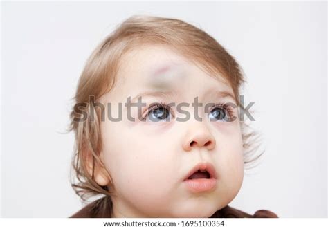 Large Bump On Childs Forehead Baby Stock Photo 1695100354 Shutterstock