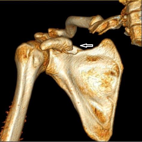 The Ct Scan Image Showing The Displaced Fracture Coracoid Download