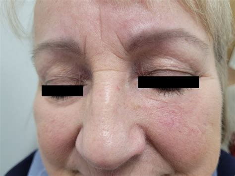 Bcc Left Lower Eyelid Dr Vindy Ghura Dermatologist Manchester