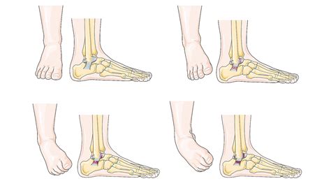 Chronic Ankle Instability Healthy Feet Podiatry