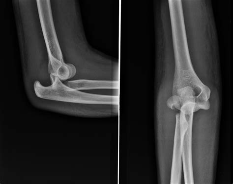 Elbow Dislocation Image