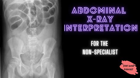 Abdominal X Ray Interpretation Youtube