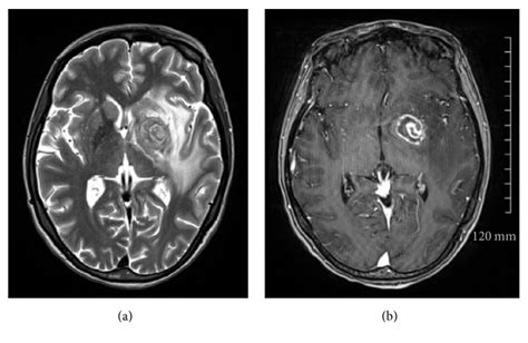 Concentric And Eccentric Target Mri Signs In A Case Of Hiv Associated