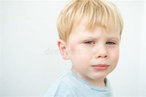 Portrait Of Little Boy With Allergic Red Spot At Face Cause By Mosquito
