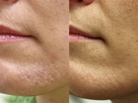 How Can I Eliminate Acne Scars Guilford Fraxel Laser And Fractional