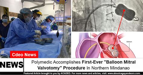 Look Polymedic Accomplishes First Ever Balloon Mitral Valvotomy Procedure In Northern Mindanao