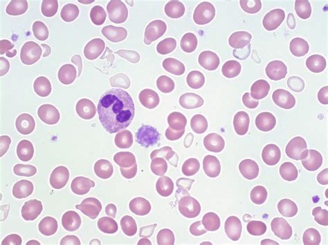 Sideroblastic Anemia A Laboratory Guide To Clinical Hematology