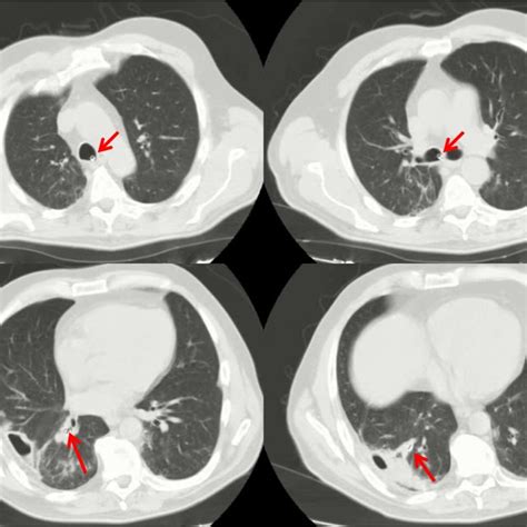 Chest Computed Tomography Scan Before A And After Treatment B