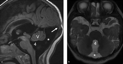 18 Mega Cisterna Magna Radiology Key