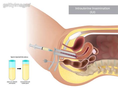 Schematic Illustration Artificial Insemination Intrauterine Insemination Iui Sperm Injected