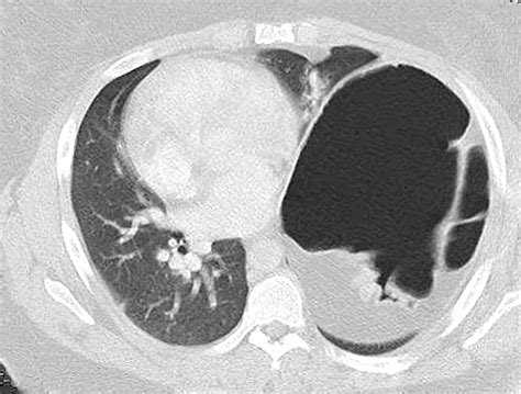 Severe Diaphragmatic Eventration Ctsnet