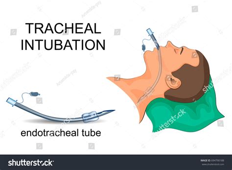 424 Tracheal Intubation Images Stock Photos And Vectors Shutterstock