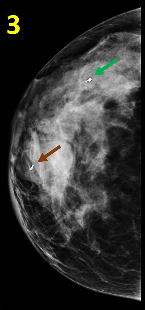Cureus Malignant Phyllodes Tumor Of The Breast In A 26 Year Old Woman