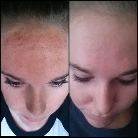 Ipl Face Treatment Before After Doctor Heck