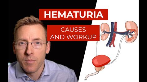 Hematuria Causes And Evaluation Of Blood In Your Urine Youtube