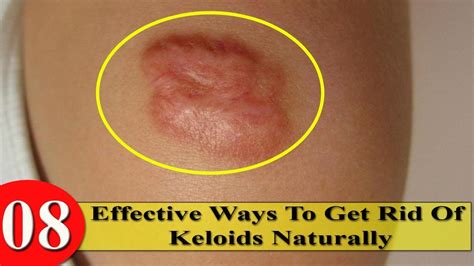 8 Effective Ways To Get Rid Of Keloids Naturally Youtube