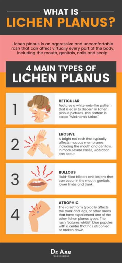 Lichen Planus 9 Natural Ways To Treat This Nasty Rash Dr Axe