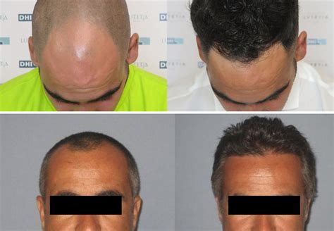 Calvitie : Ma greffe de cheveux ! (DHI)