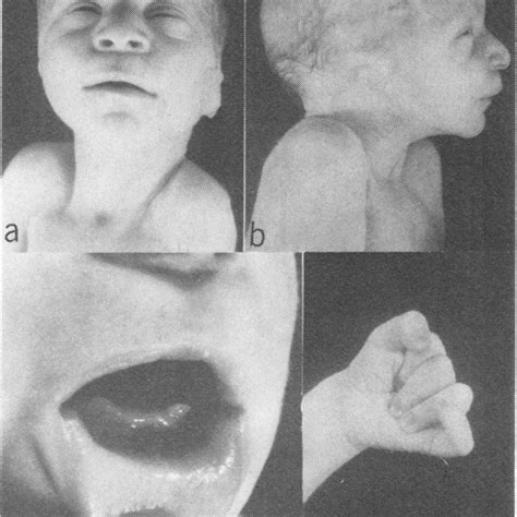 Gross Appearance Ofpatient Showing Peculiar Facies A B Natal Tooth Download Scientific