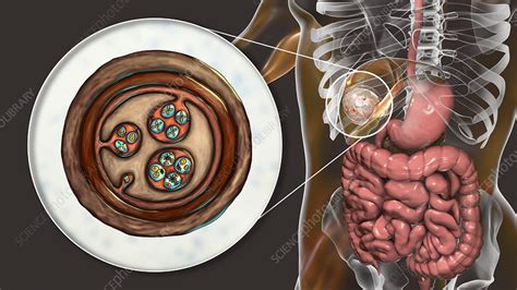 Hydatid Disease In Liver Cystic Echinococcosis Illustratio Stock