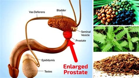 Natural Remedies For Enlarged Prostate Gland With Video