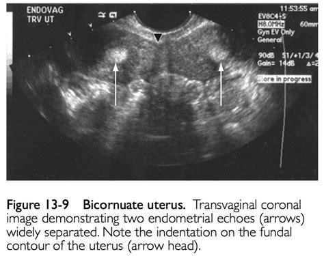 Uterine Ultrasound Imaging