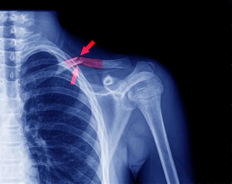 X Ray Broken Collar Bone Broken Collarbone Symptoms And Causes