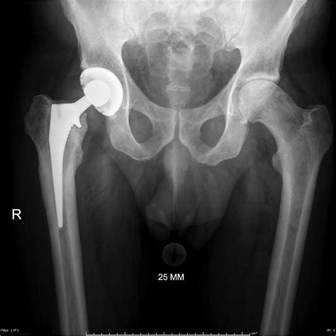 Loosening Of Hip Prosthesis Radiology Case