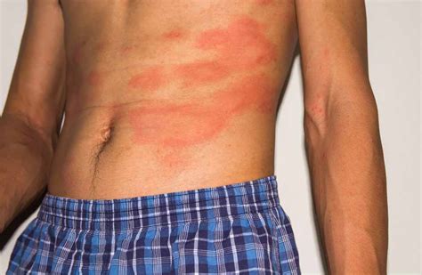 Red Spots On Skin How To Spot Skin Cancer What It Looks Like And
