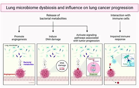 Lung Microbiome Dysbiosis And Influence On Lung Cancer Progression