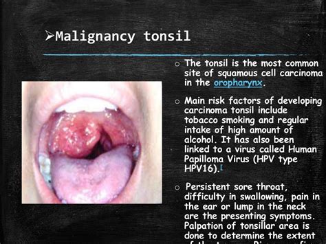 White Patch On The Tonsil Differential Diagnosis