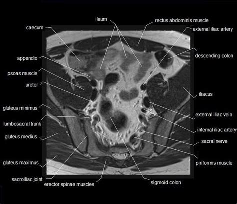 The muscles of the pelvis form its floor. MRI pelvis anatomy | free male pelvis axial anatomy