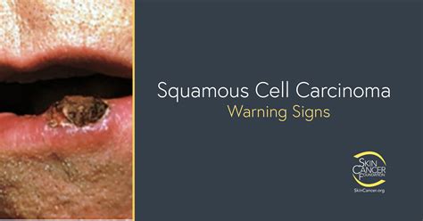 Squamous Cell Carcinoma Warning Signs And Images The Skin Cancer